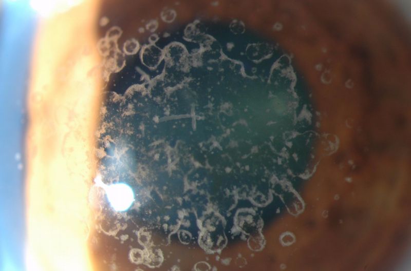 Un ojo que sufre distrofia corneal
