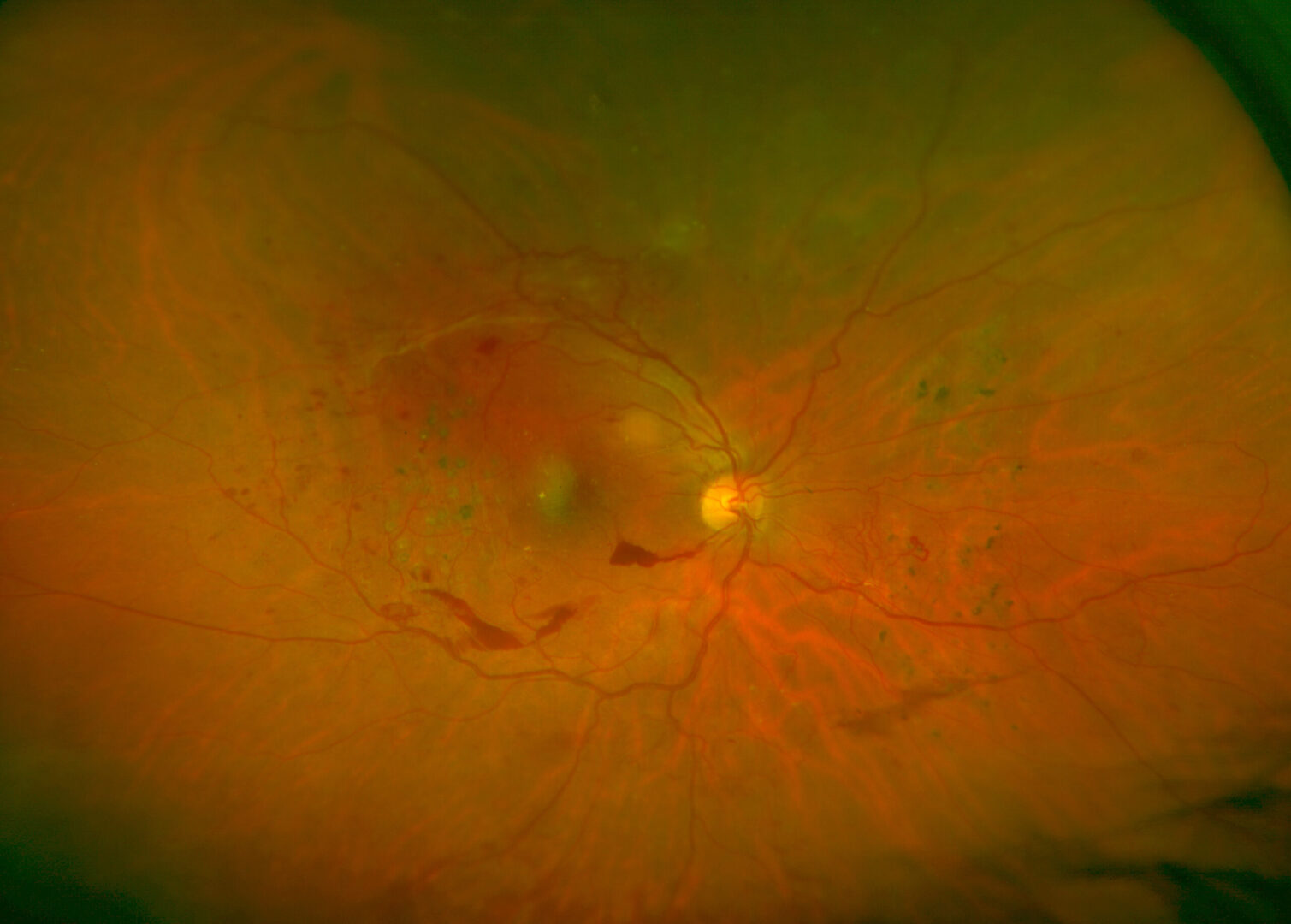 Diabetic retinopathy