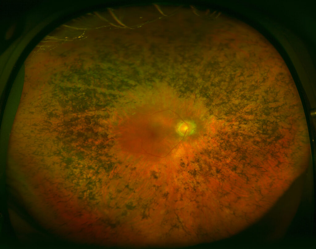 Retinitis Pigmentosa Miranza