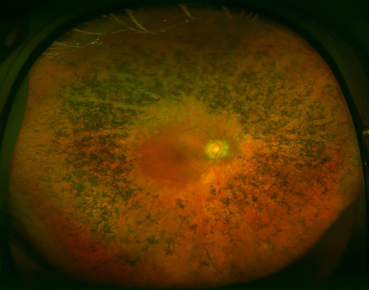 retinitis pigmentosa before and after