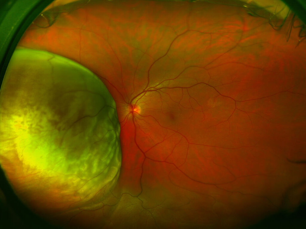 tumor ocular