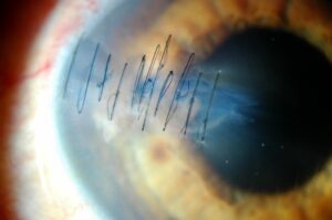 Esta imagen muestra un ojo suturado a causa de un traumatismo ocular