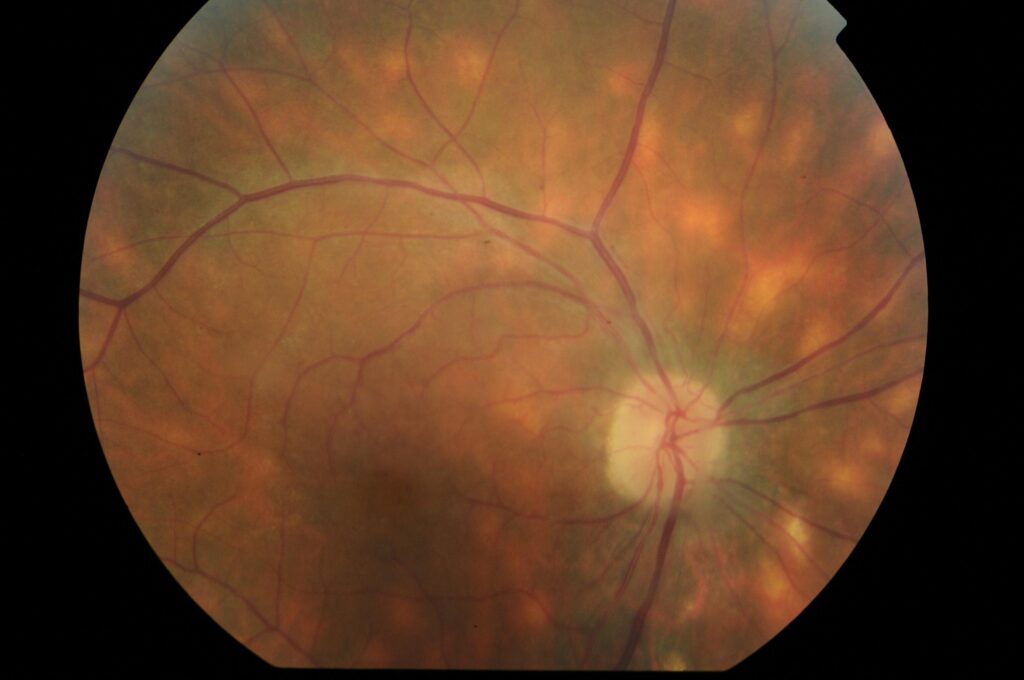 UVEITIS