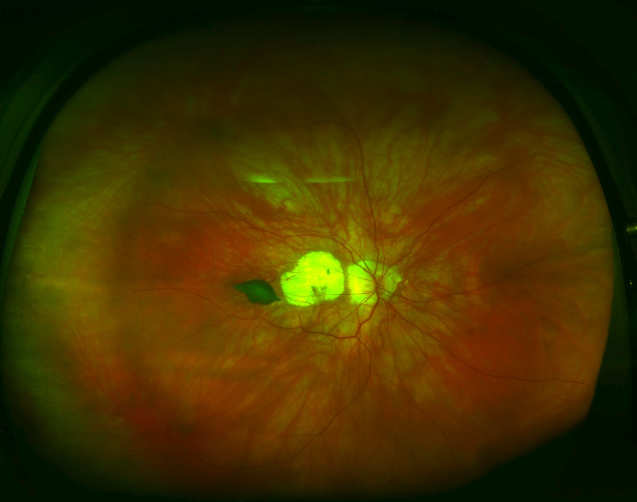 pathological myopia signs