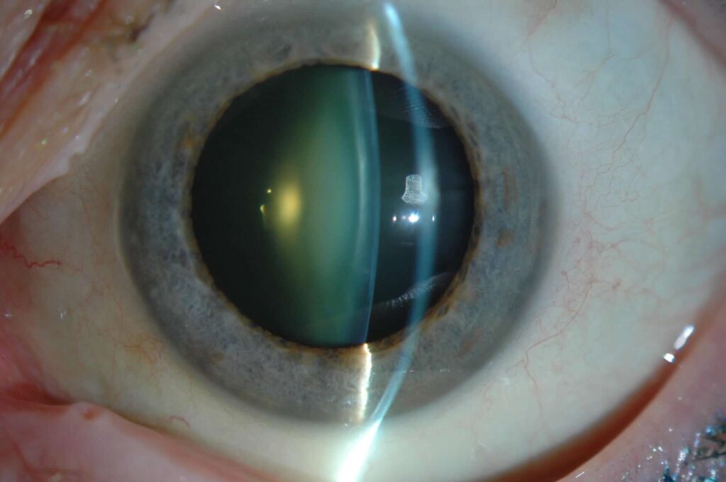 Un ojo que sufre cataratas, el cristalino tiene menos transparencia de lo normal