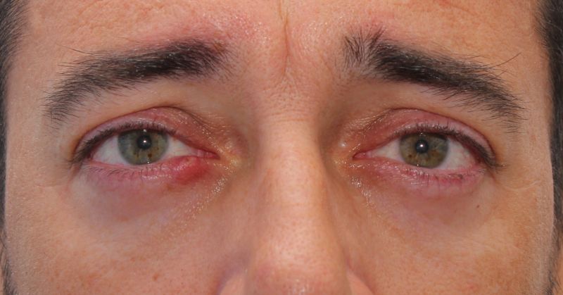 chalazion removal