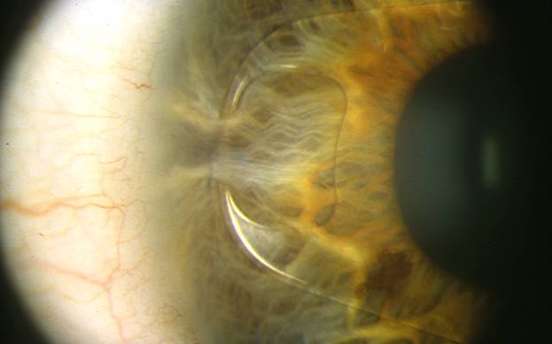 cirugia refractiva con lente intraocular