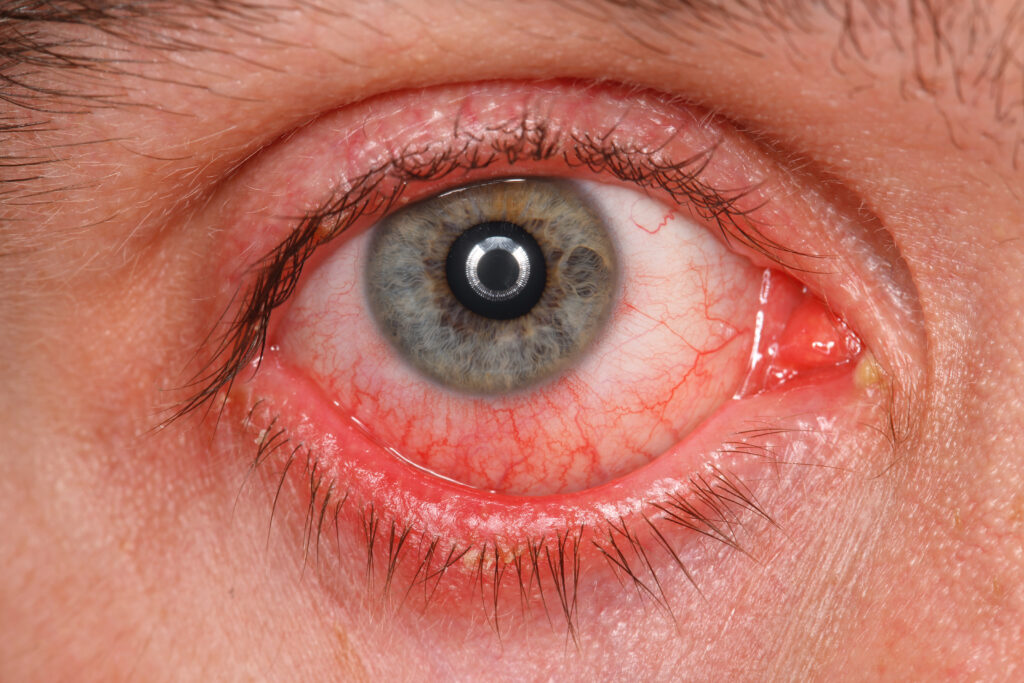 conjuntivitis