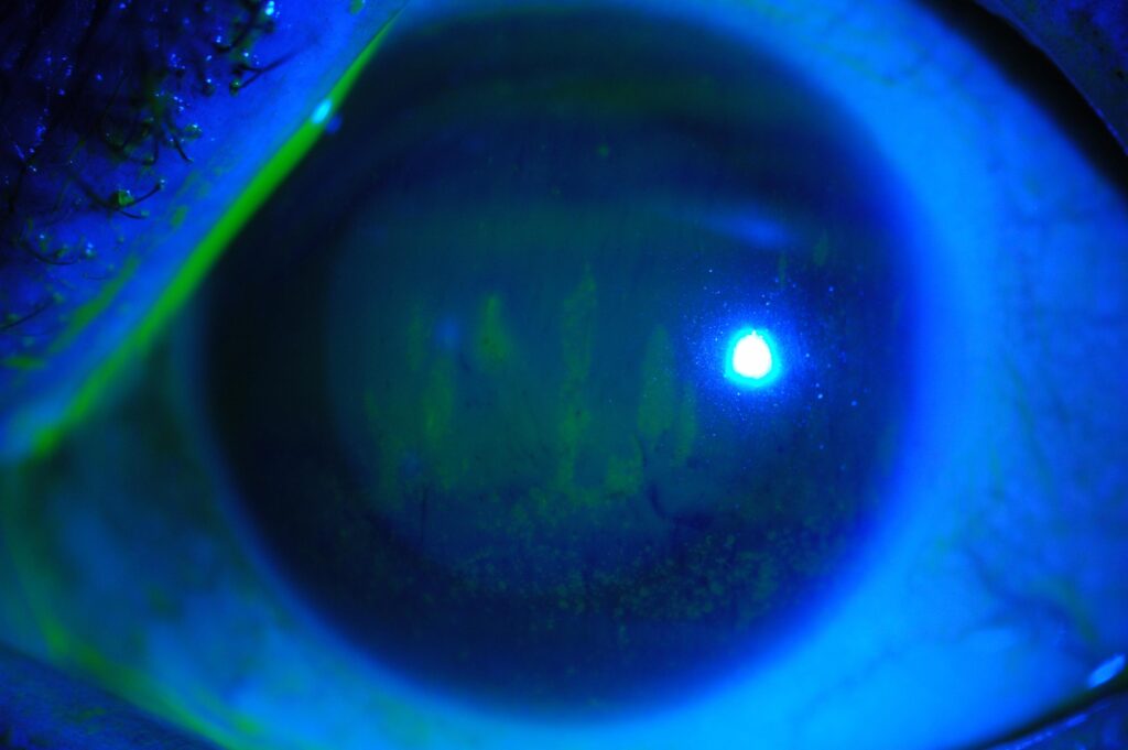 Un ojo con síndrome del ojo seco.