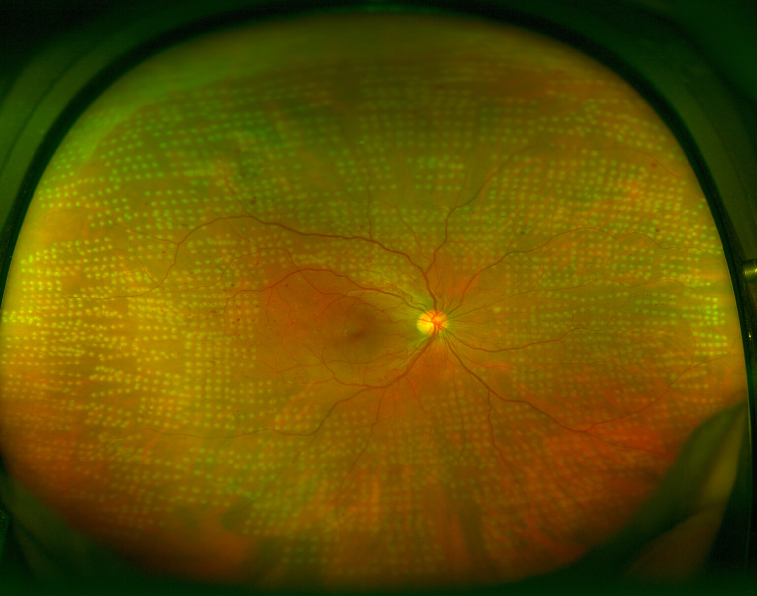 Fotocoagulación láser. Tratamientos oftalmológicos Miranza