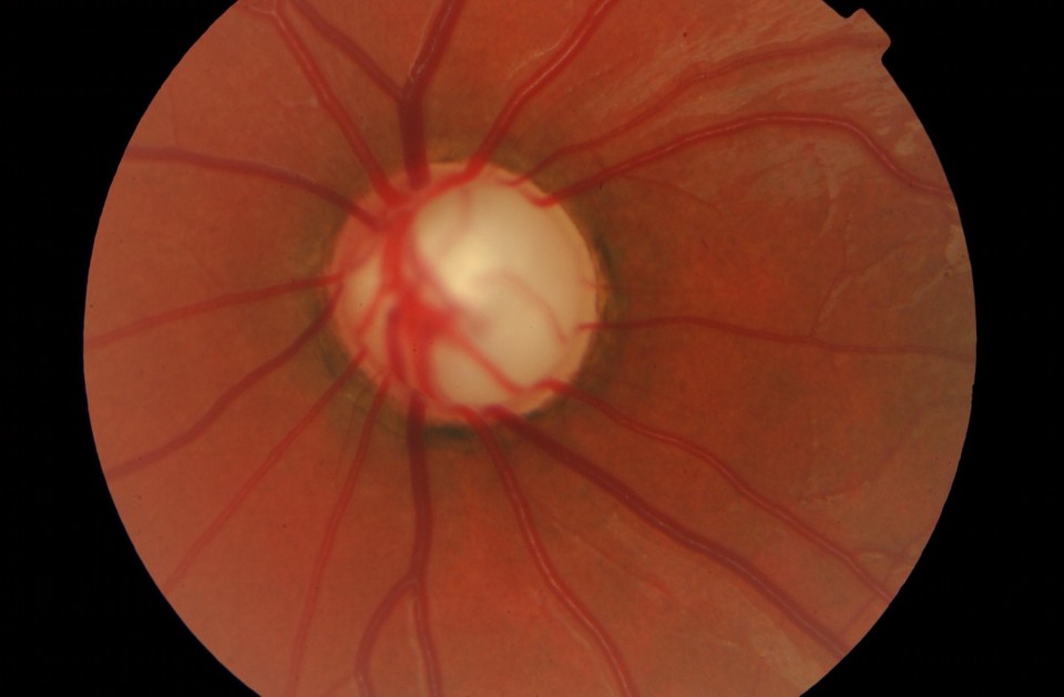 Con qué aparatos medimos la PIO? Glaucoma Parte 2. - Clínica VISIONKER