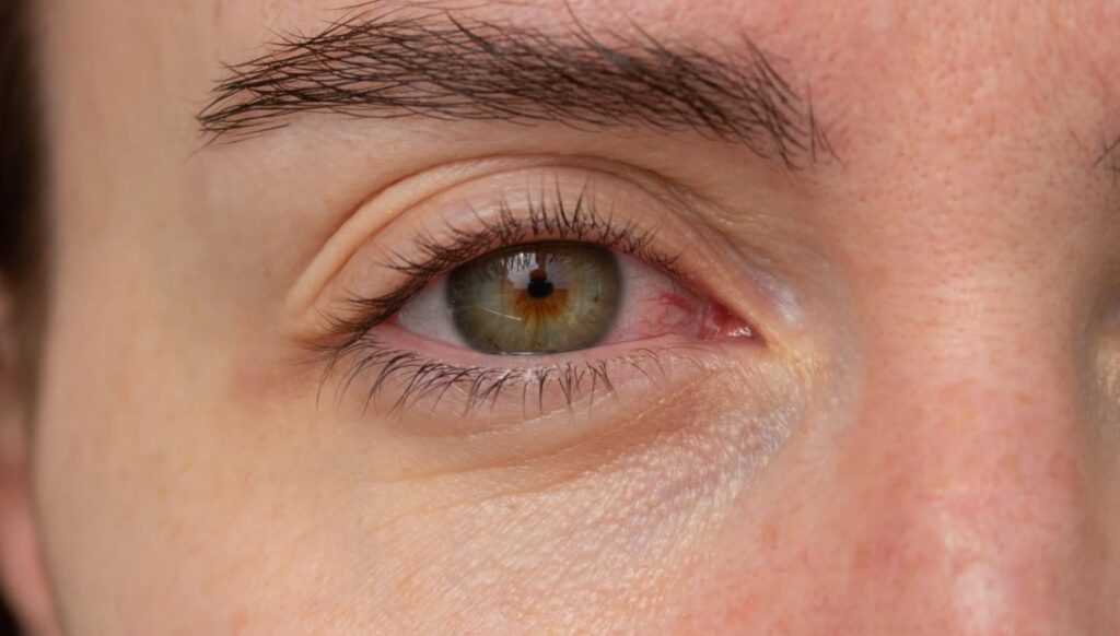 conjuntivitis bacteriana