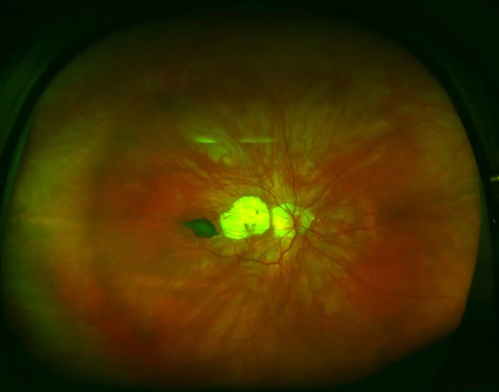 Esta imagen muestra un ojo que sufre una alta miopía