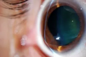 Un ojo afectado por queratocono