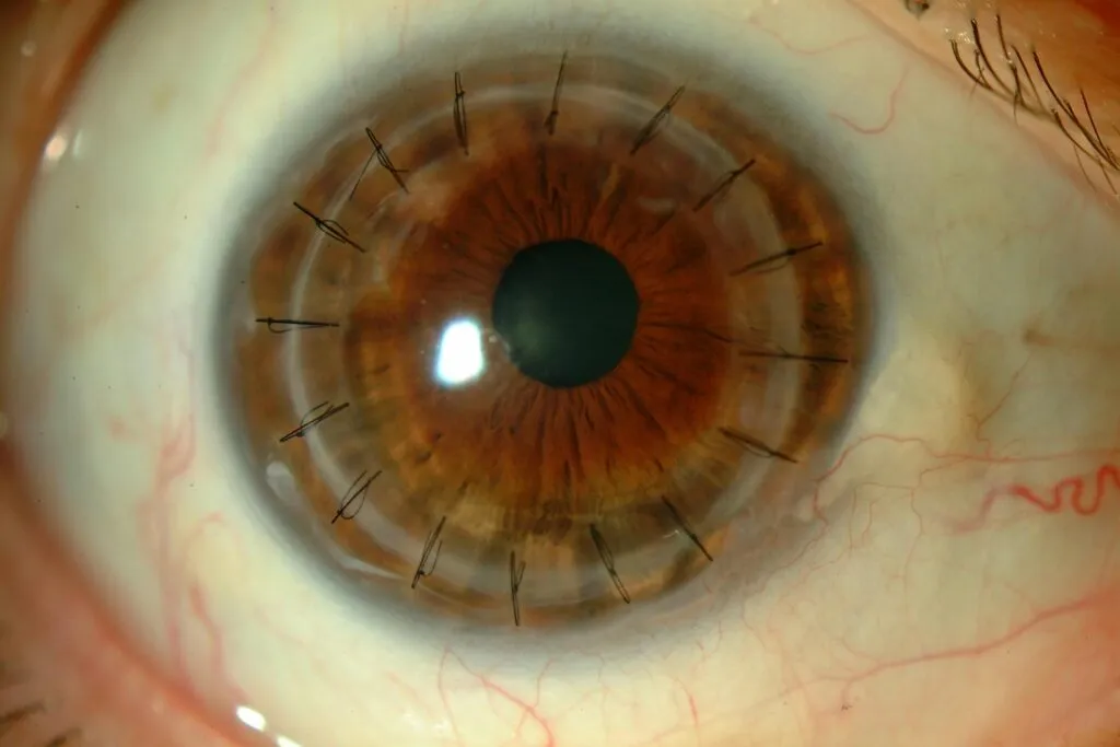 Un ojo que sufre problemas de córnea
