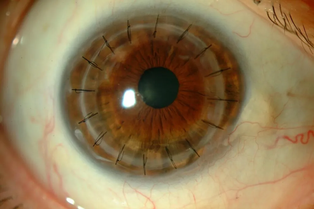 trasplante cornea