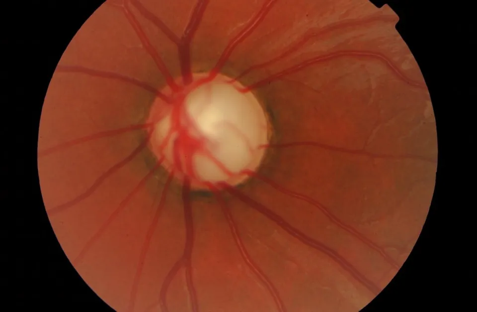 Fondo de ojo con nervio óptico afectado por glaucoma