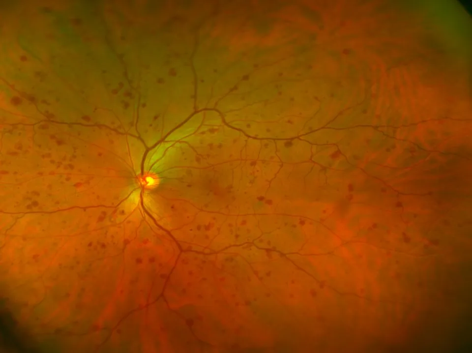 retina con retinopatía diabética